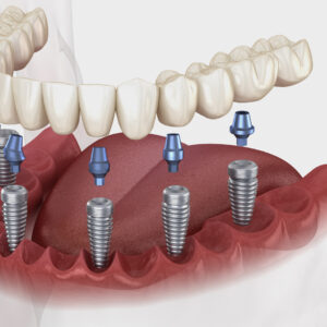 Implants