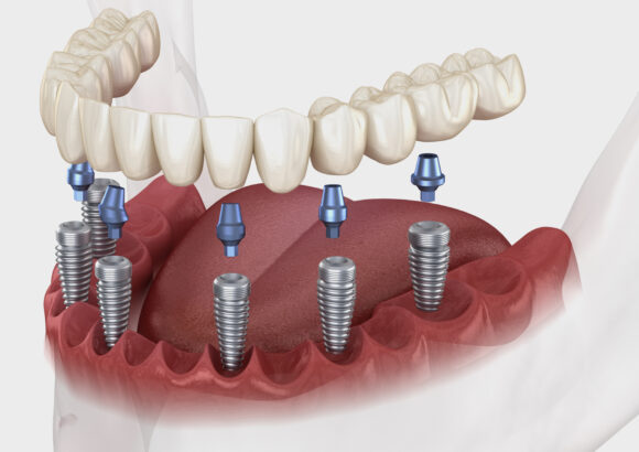 Implants
